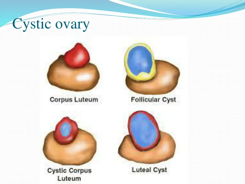 cystic ovary