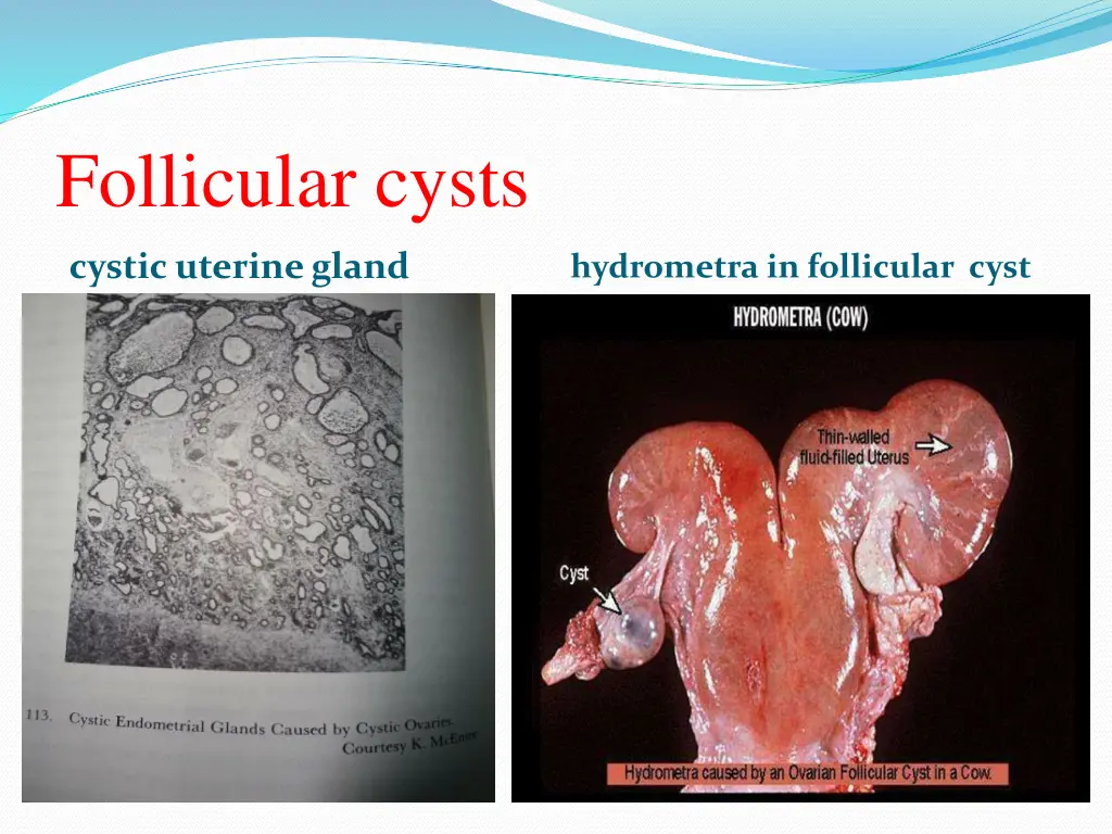 follicular cysts 2