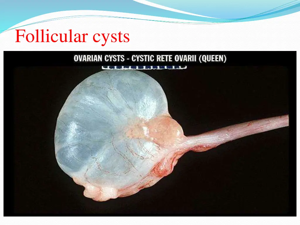 follicular cysts 3