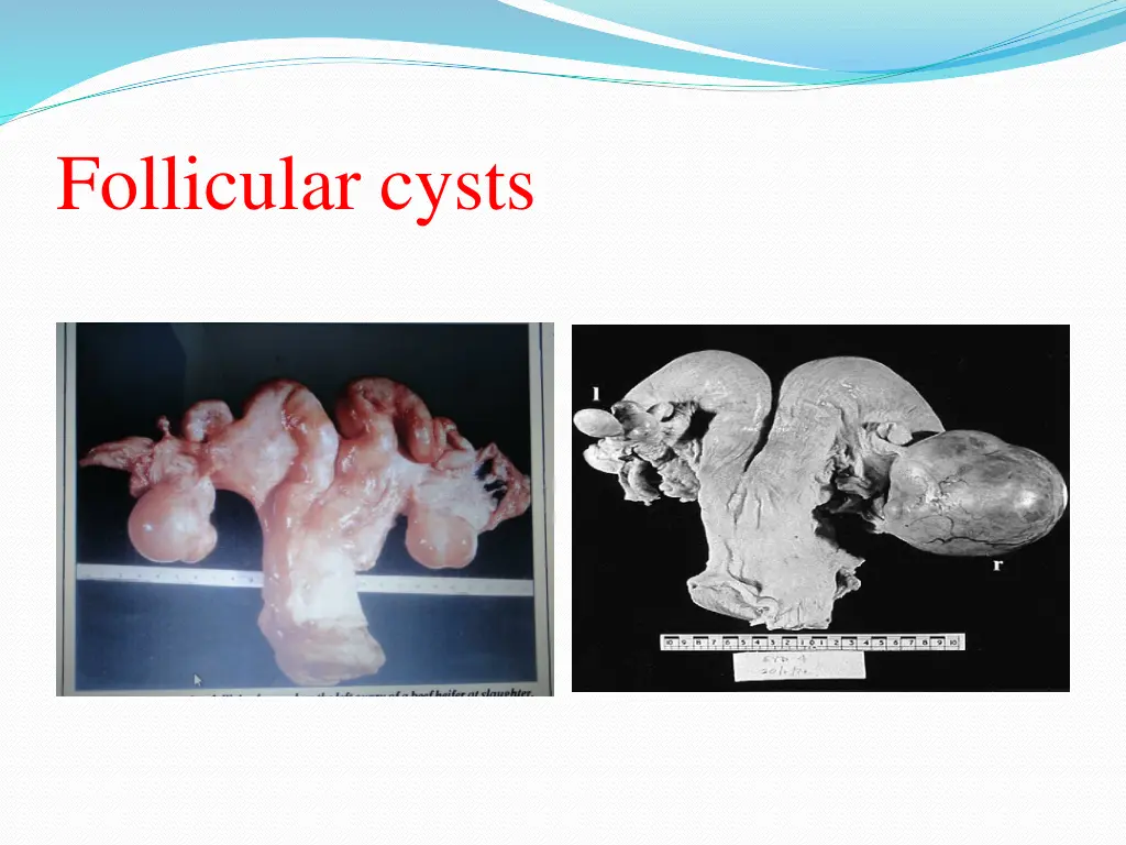 follicular cysts