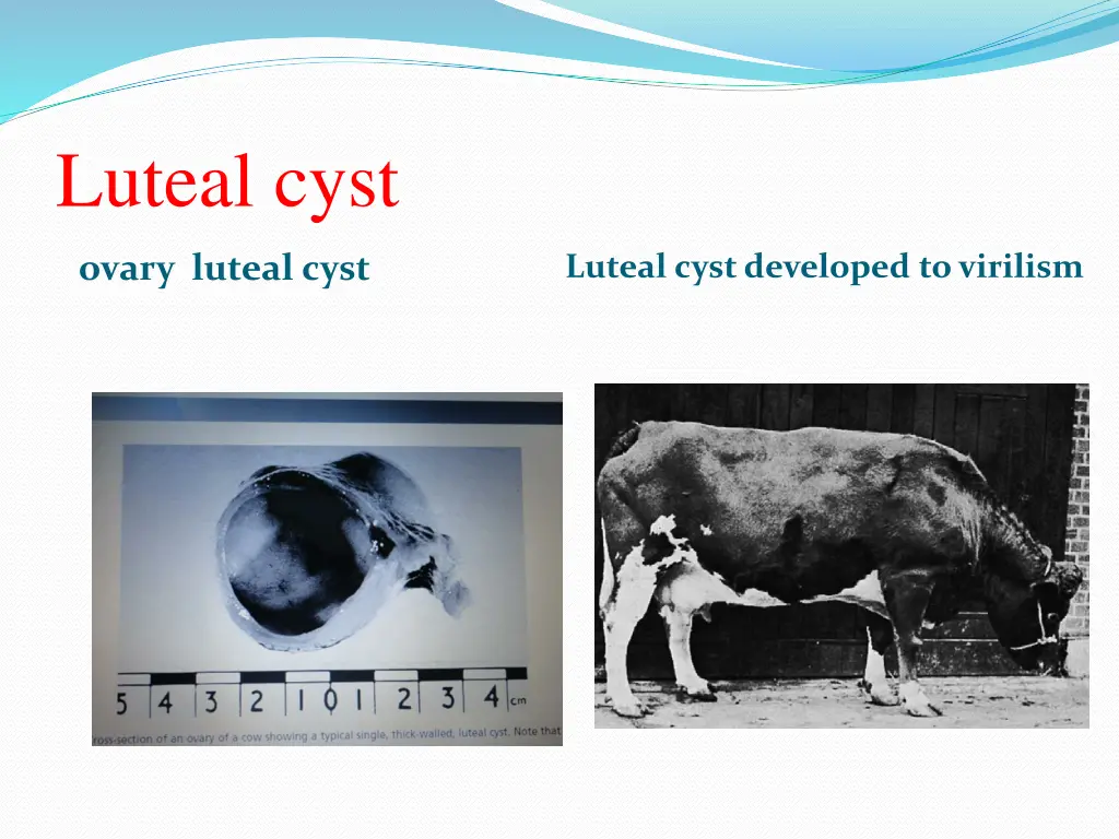 luteal cyst 1