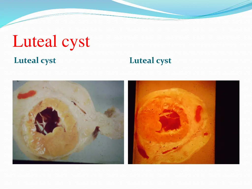 luteal cyst