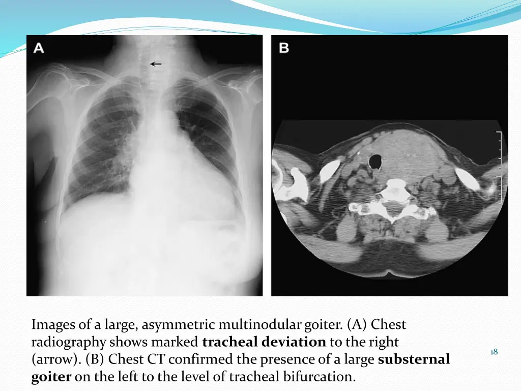 images of a large asymmetric multinodular goiter