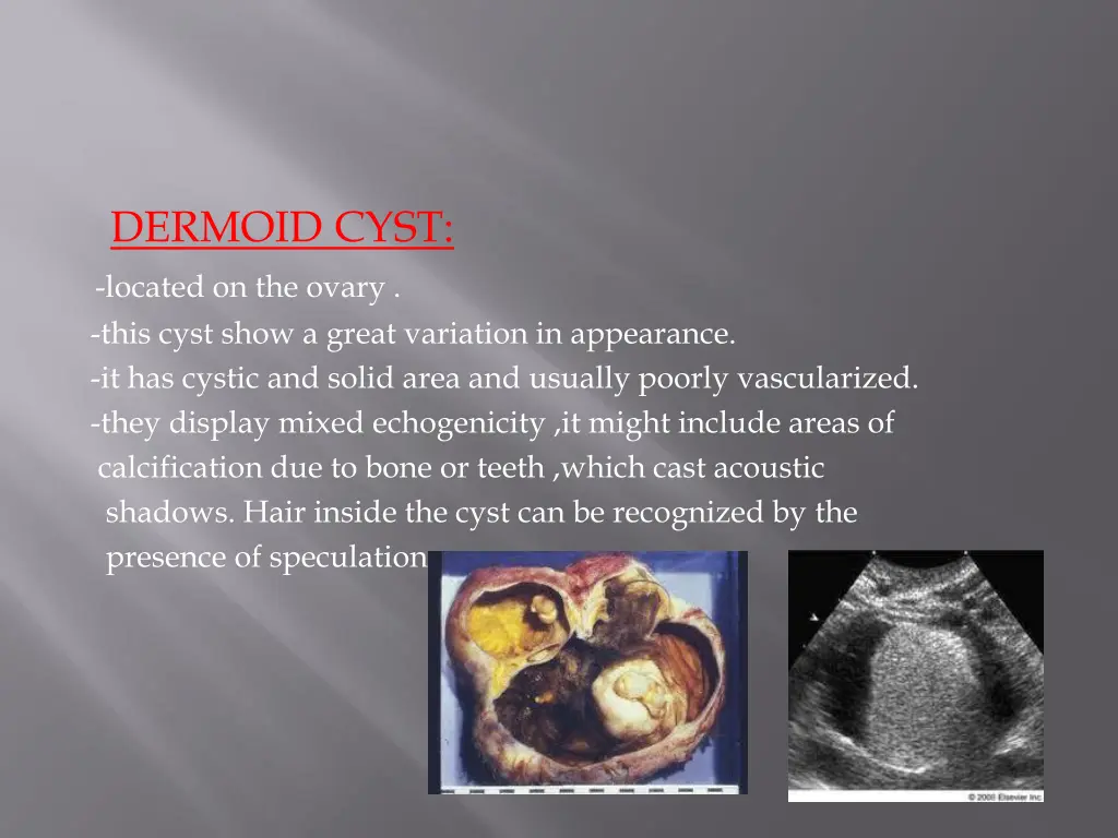 dermoid cyst located on the ovary this cyst show