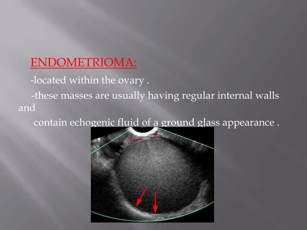 endometrioma located within the ovary these