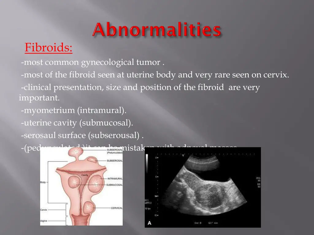 fibroids most common gynecological tumor most