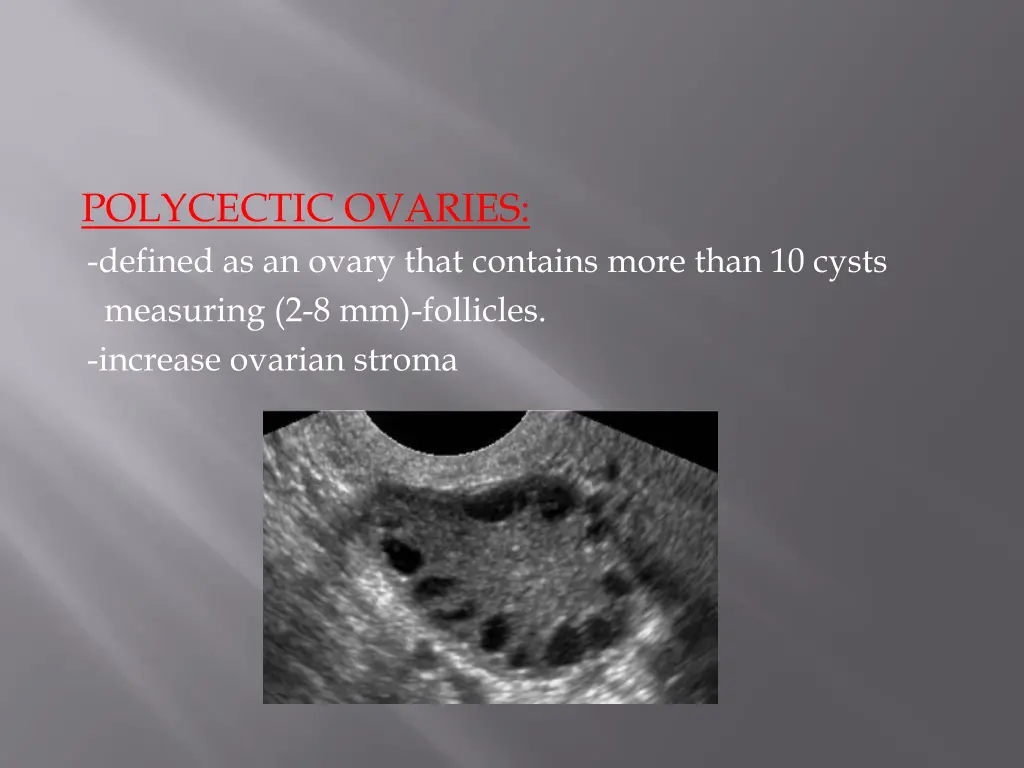 polycectic ovaries defined as an ovary that