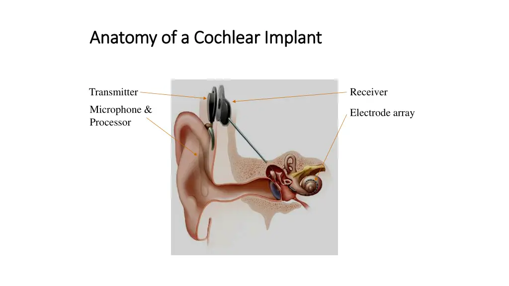 anatomy of a cochlear implant anatomy