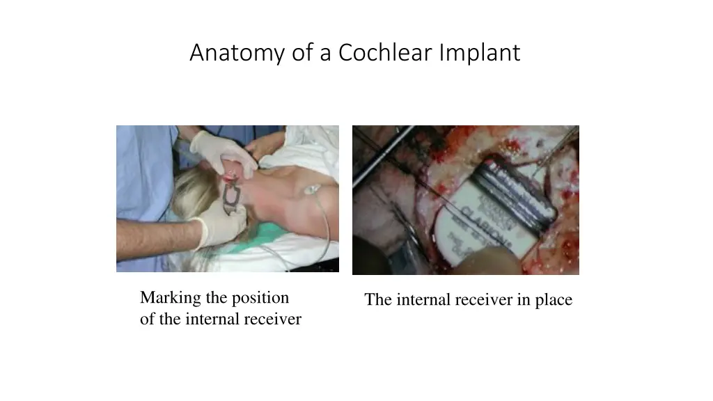 anatomy of a cochlear implant