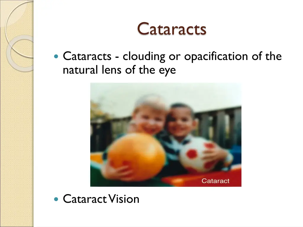 cataracts