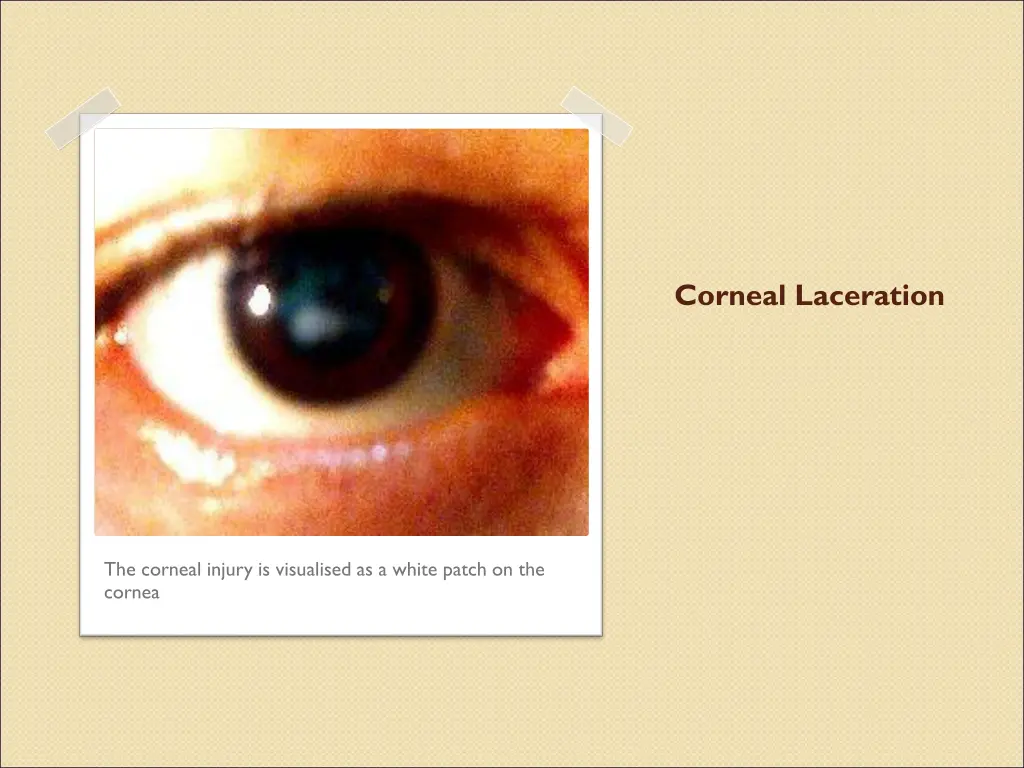 corneal laceration