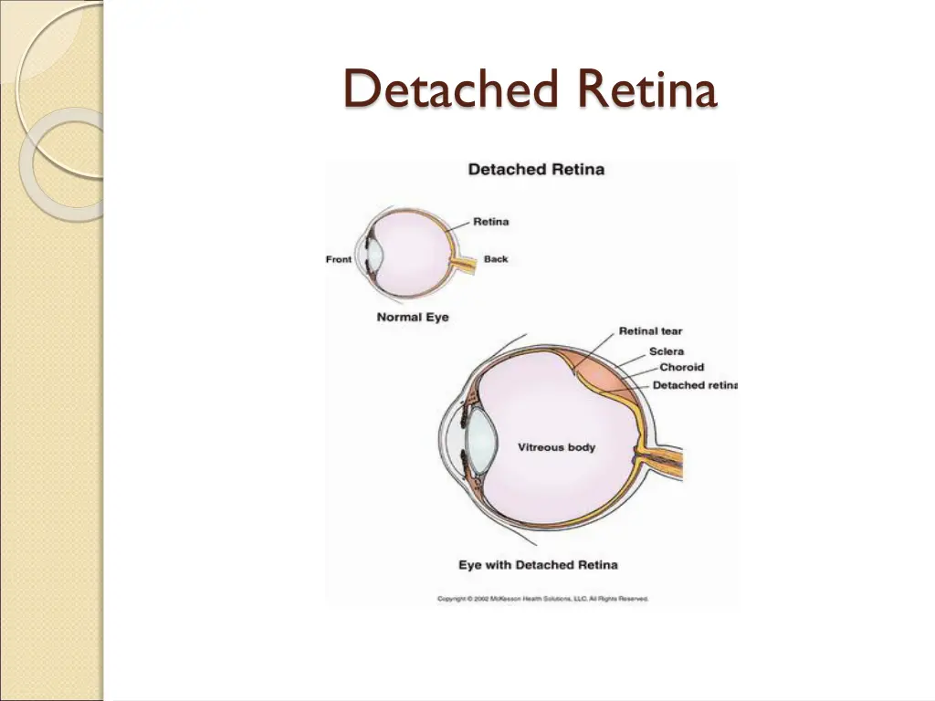 detached retina