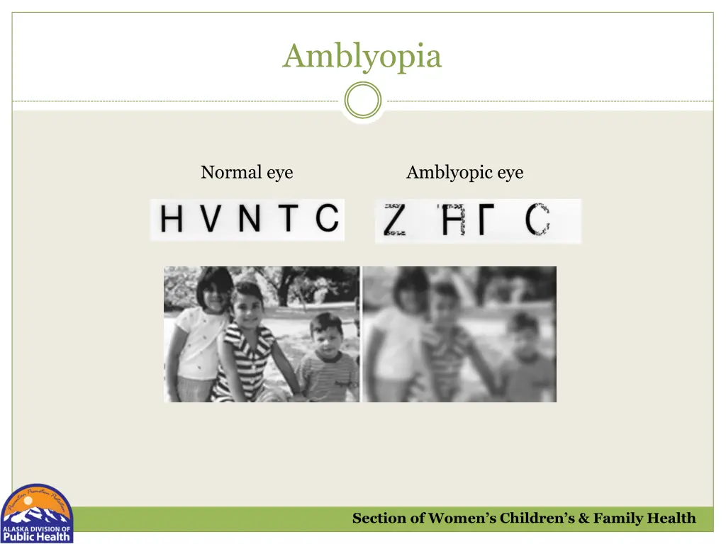 amblyopia 1