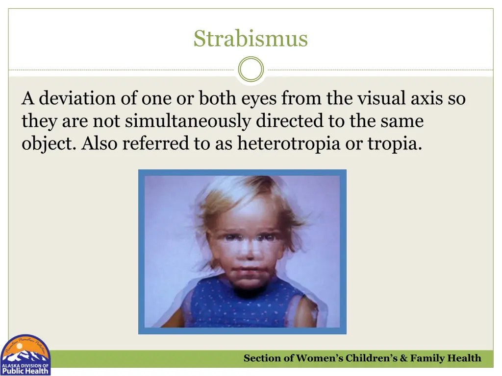 strabismus