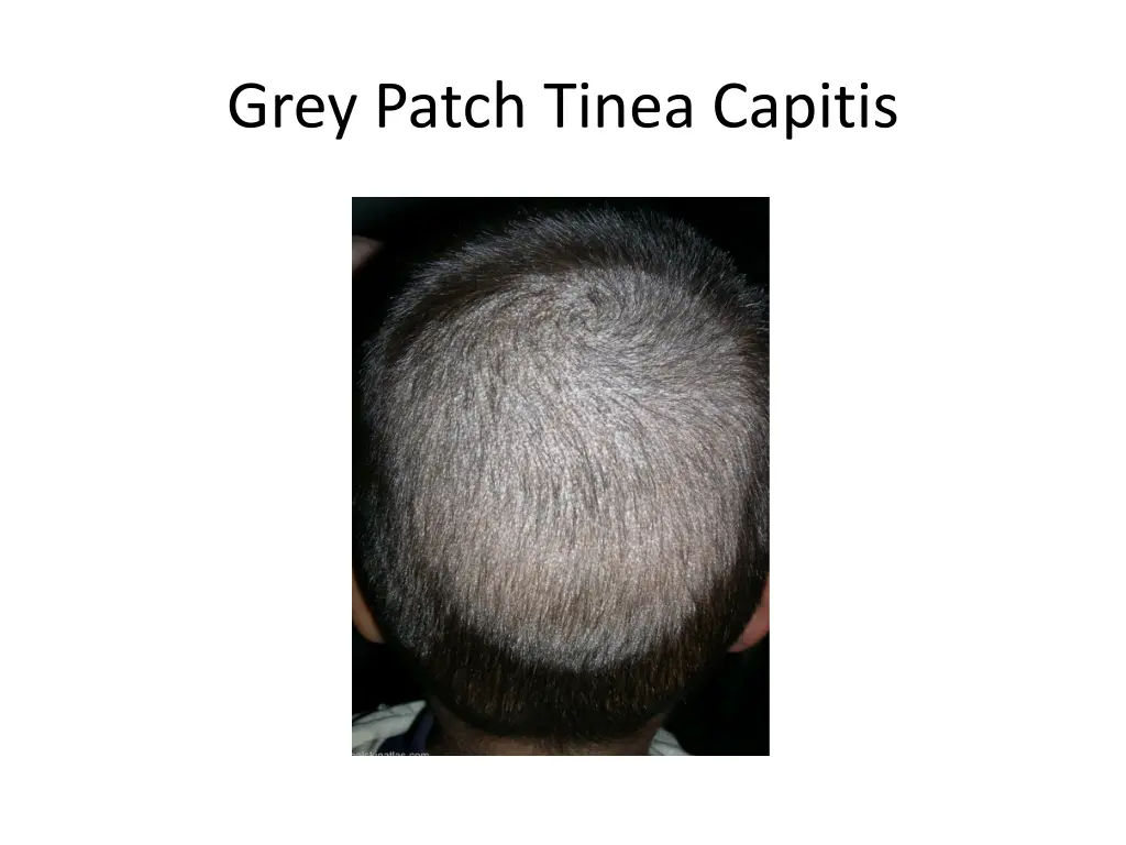 grey patch tinea capitis