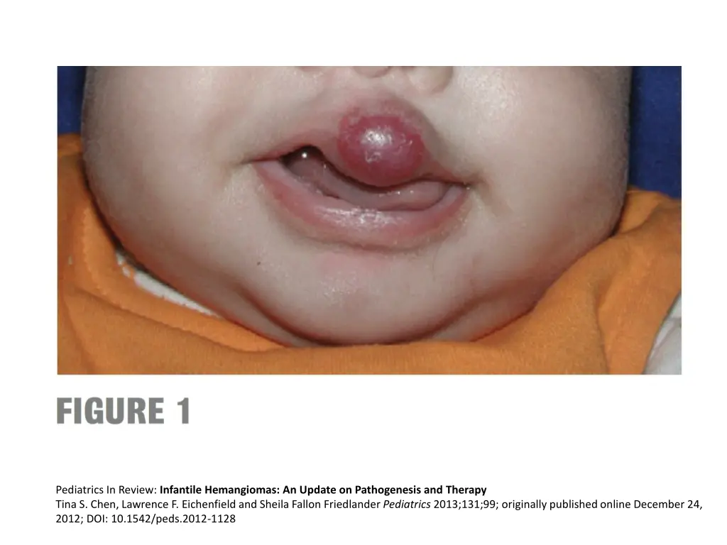 pediatrics in review infantile hemangiomas