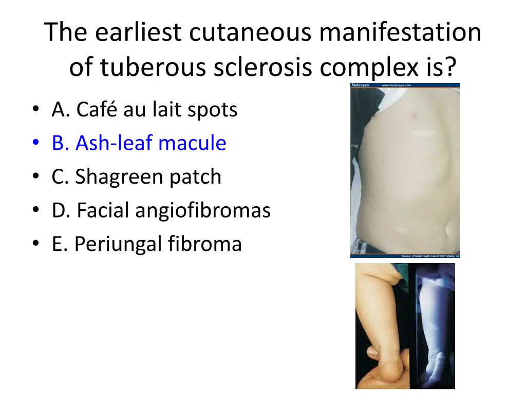 the earliest cutaneous manifestation of tuberous 1