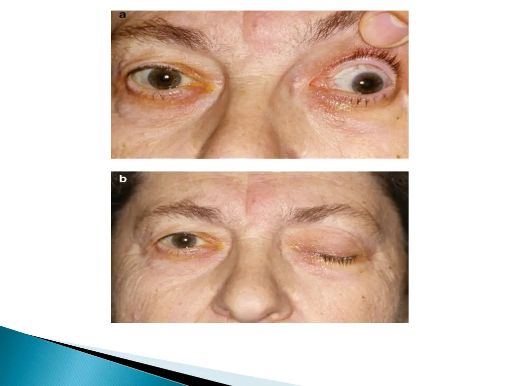 occulomotor nerve palsy