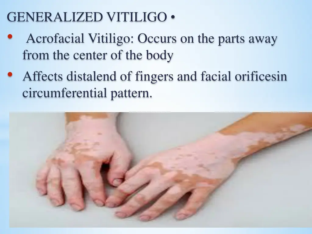 generalized vitiligo acrofacial vitiligo occurs