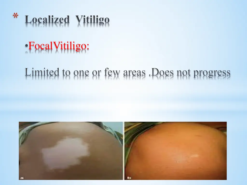 localized vitiligo