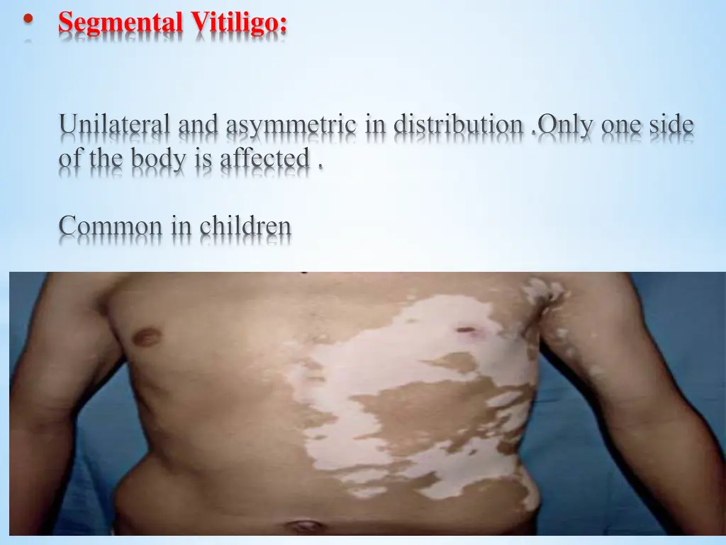 segmental vitiligo