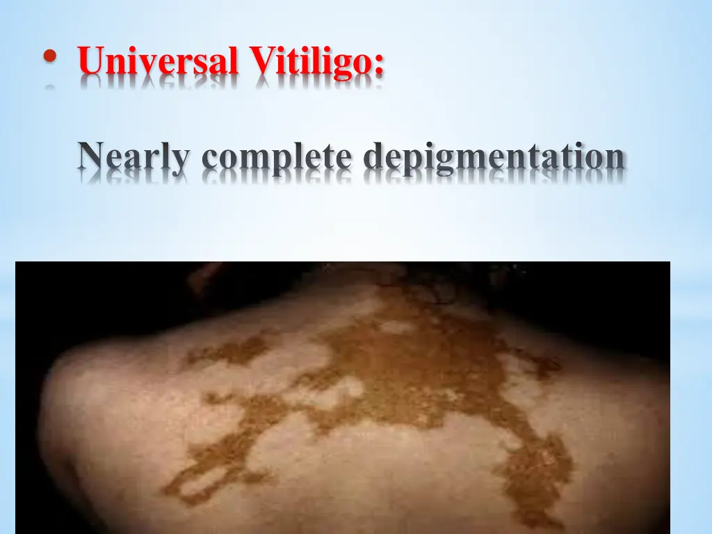 universal vitiligo