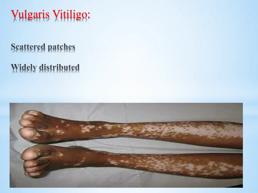 vulgaris vitiligo