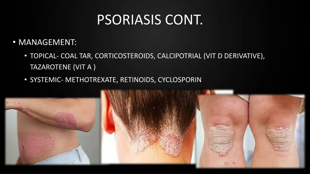 psoriasis cont