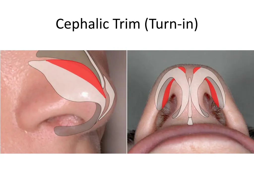 cephalic trim turn in