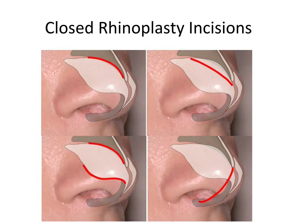 closed rhinoplasty incisions