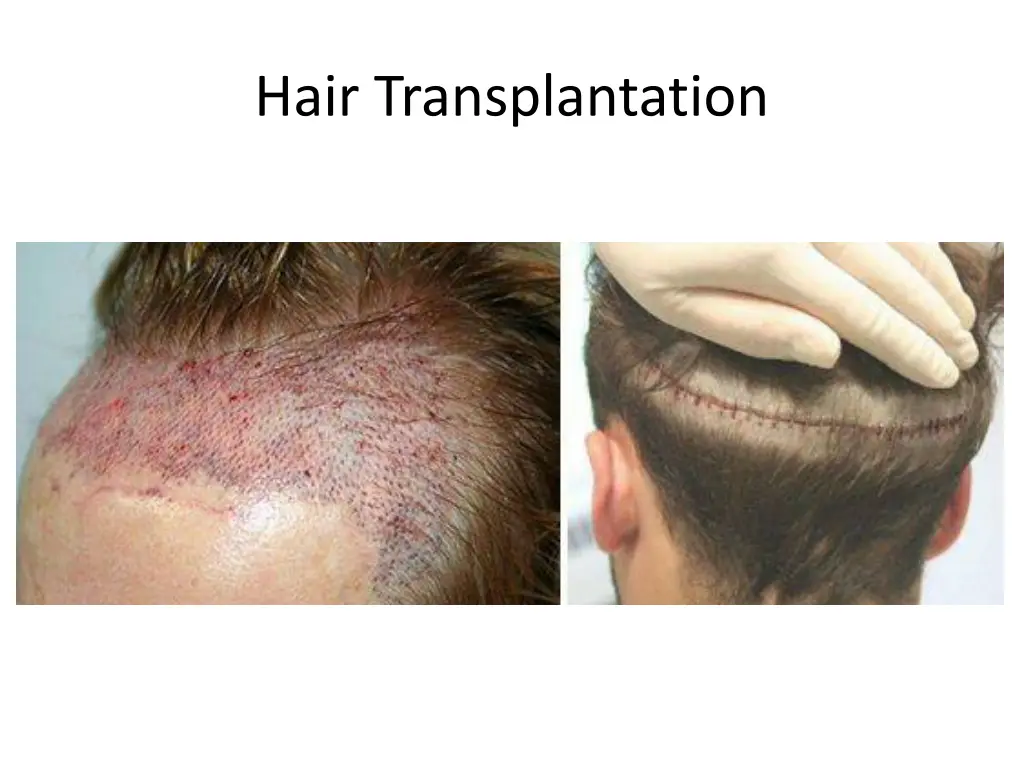 hair transplantation 2