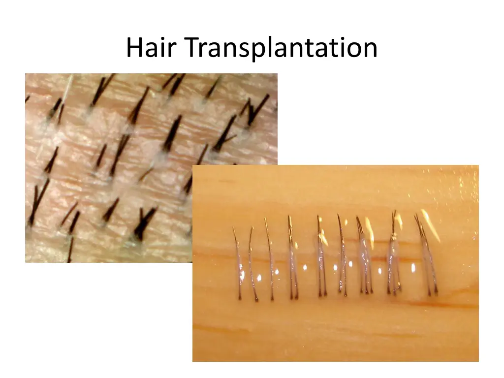 hair transplantation 3