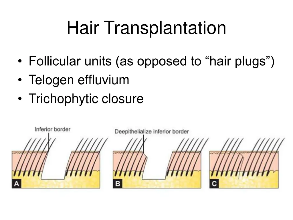 hair transplantation 4