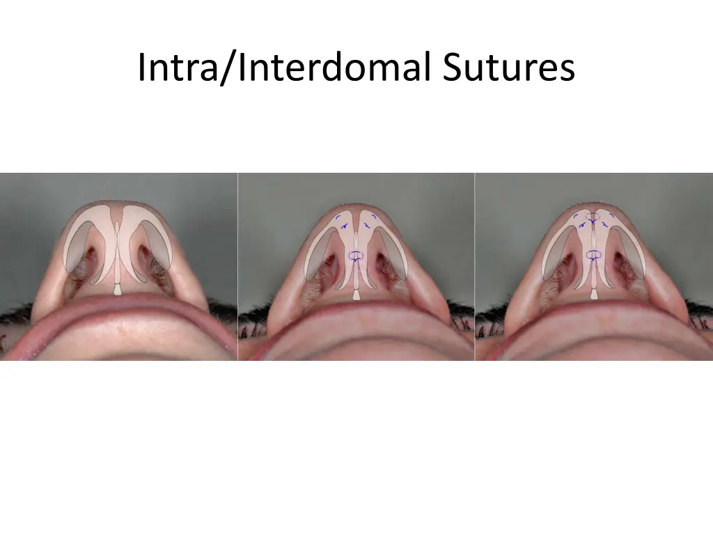 intra interdomal sutures