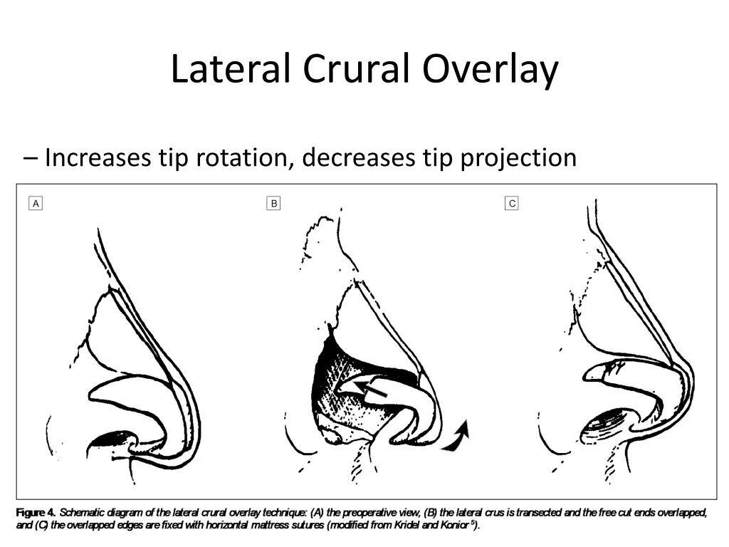 lateral crural overlay