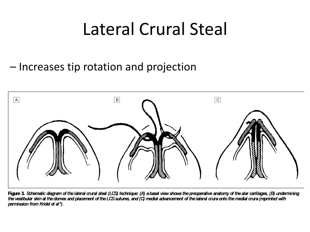 lateral crural steal