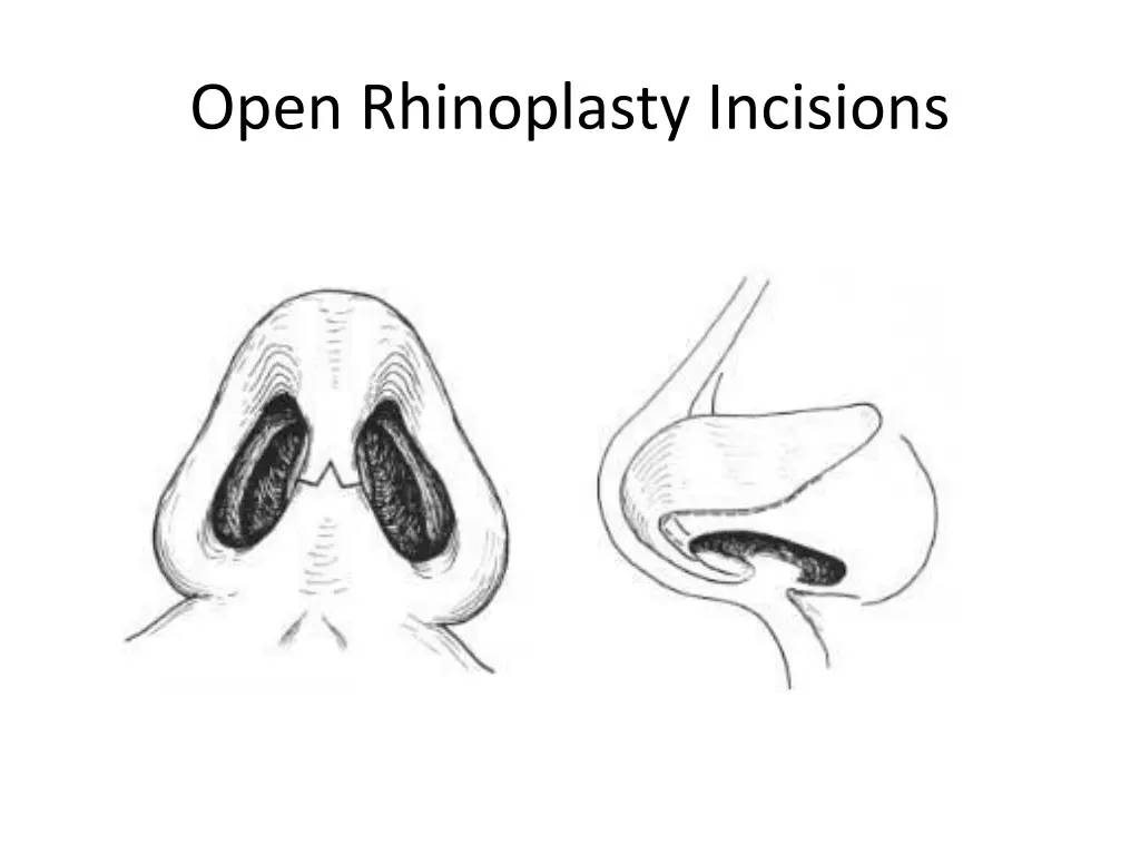 open rhinoplasty incisions