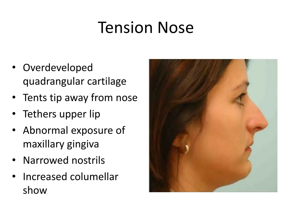 tension nose