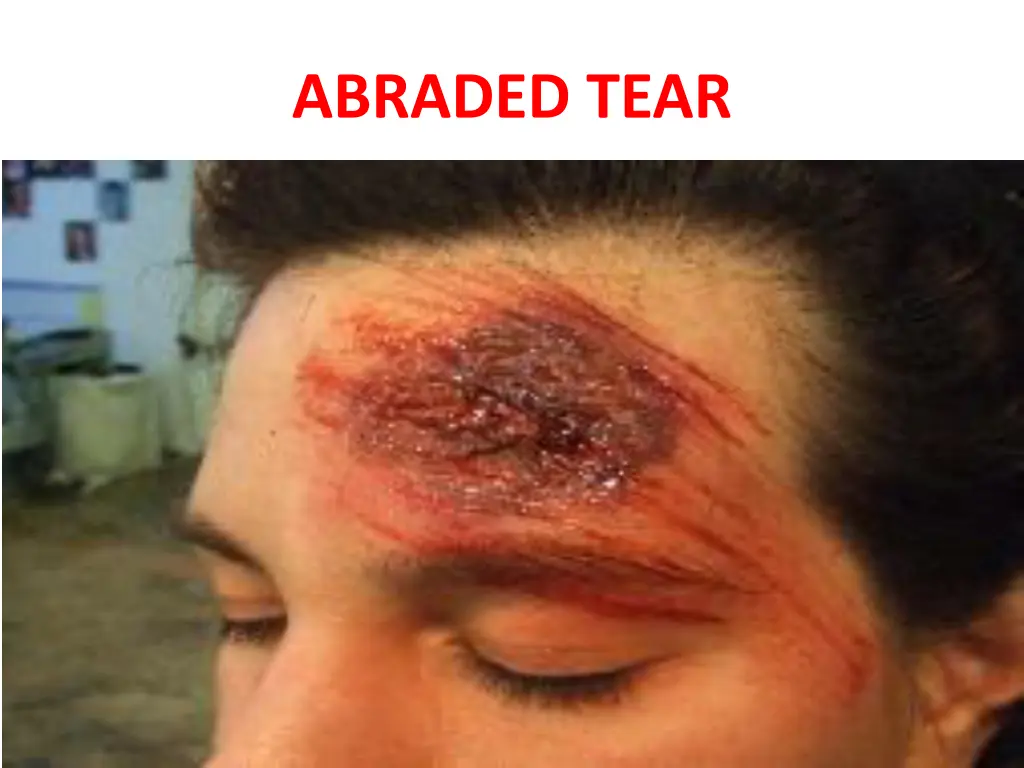 abraded tear