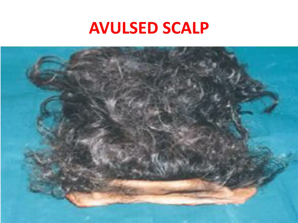 avulsed scalp