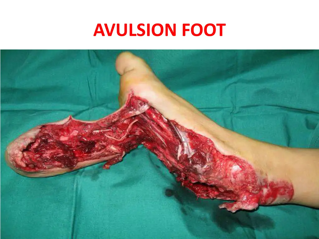 avulsion foot