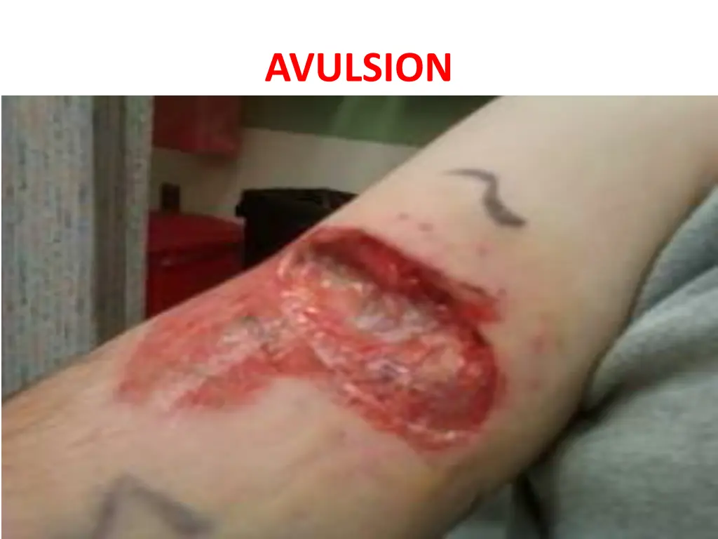 avulsion