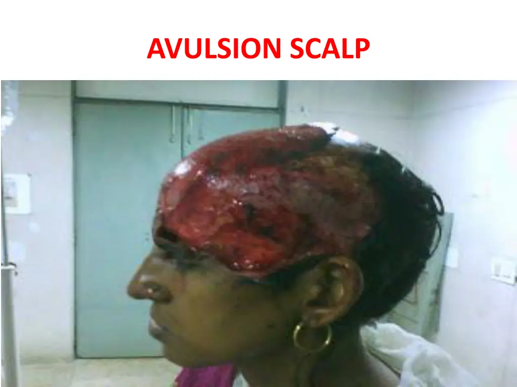 avulsion scalp 1