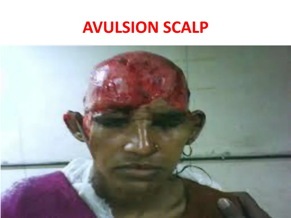 avulsion scalp