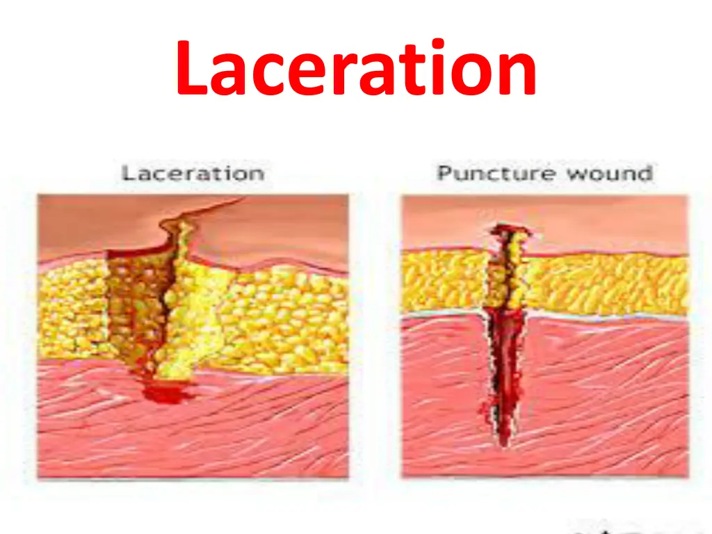 laceration 2