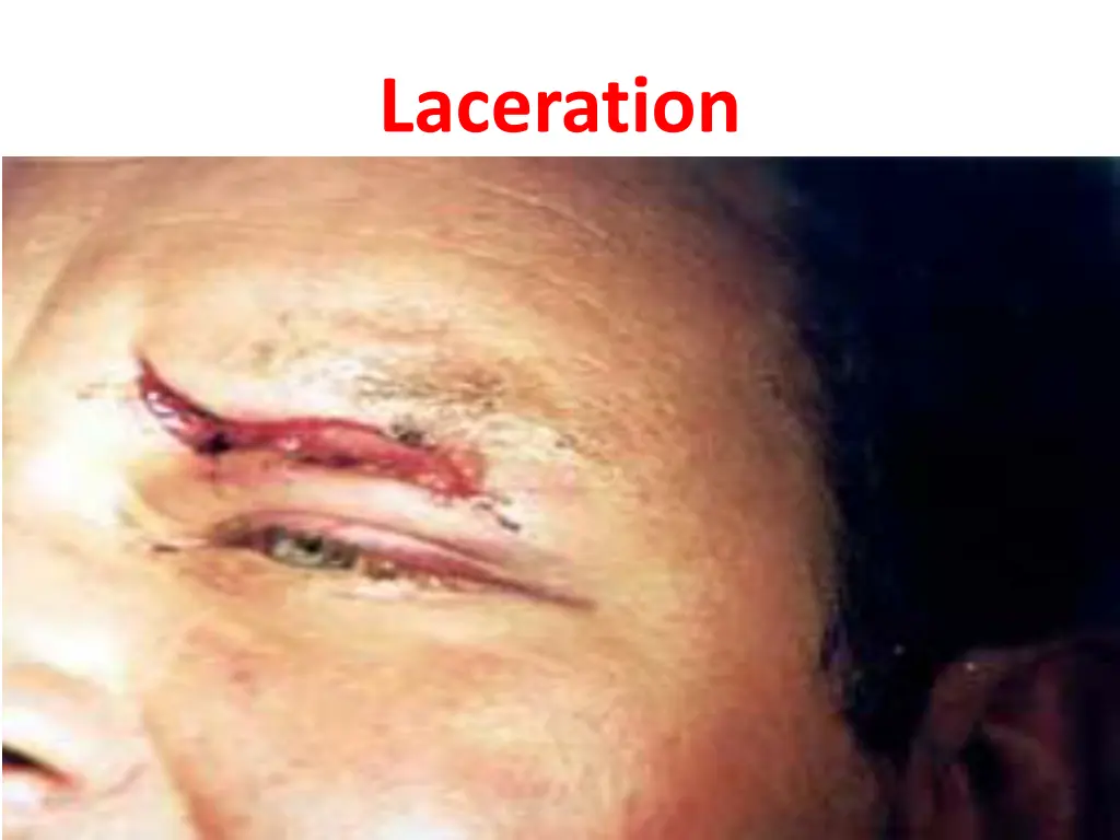 laceration 3