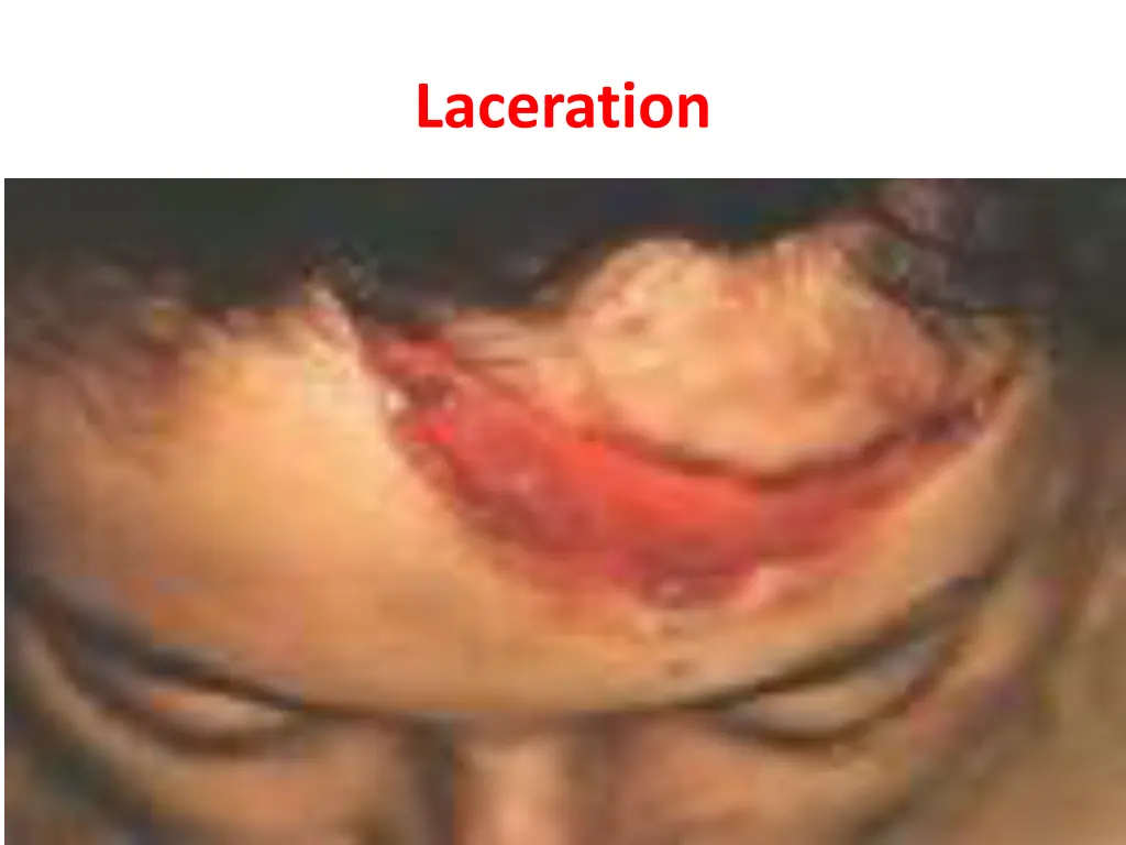 laceration 4