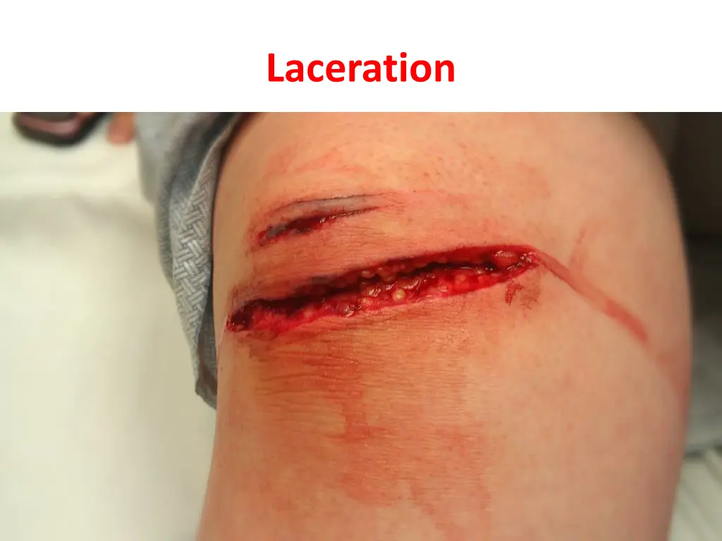 laceration 5