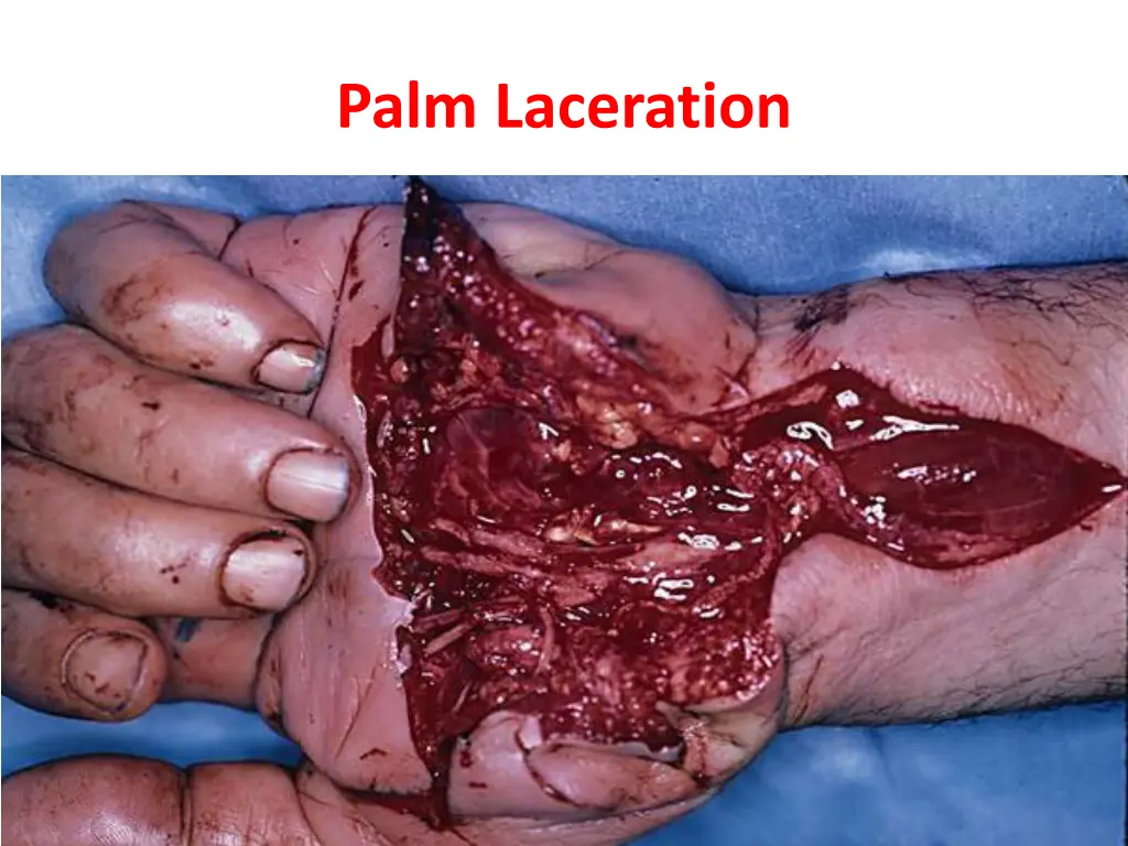 palm laceration