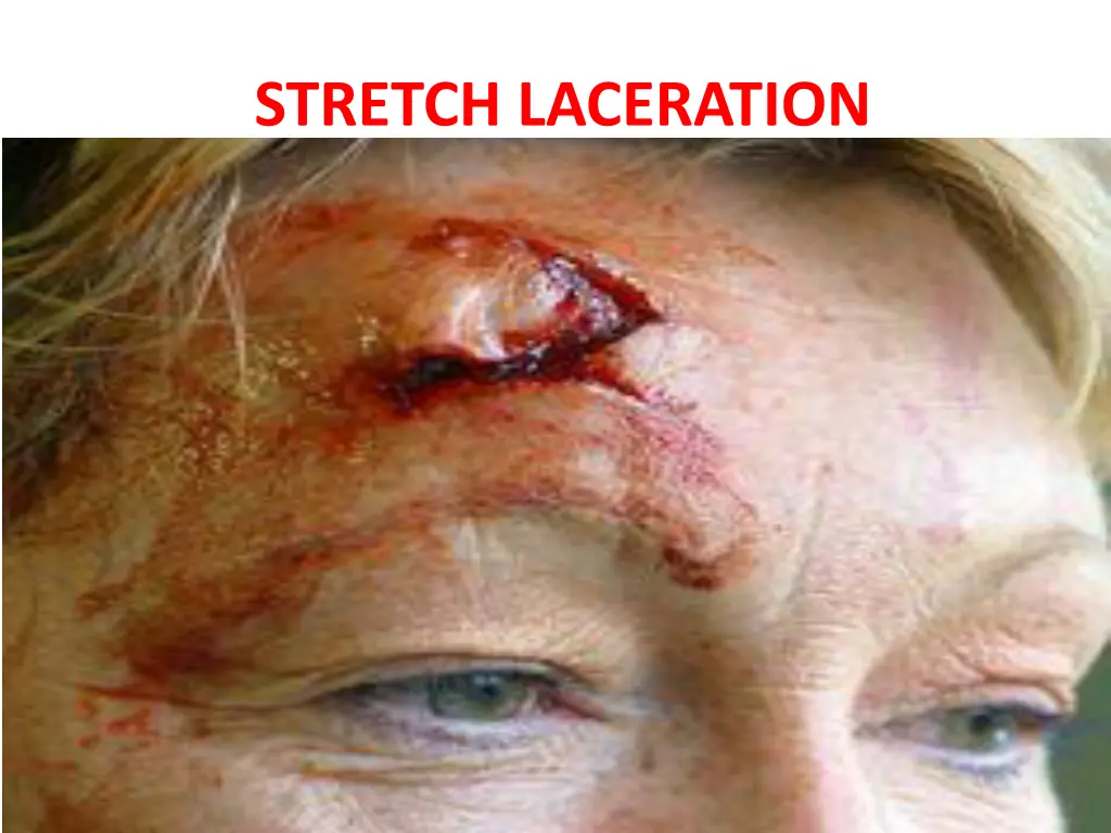 stretch laceration